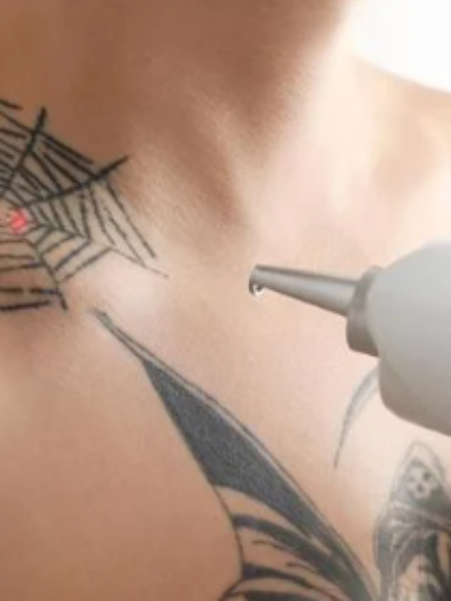 Remoção de tatuagem Vale a Pena?